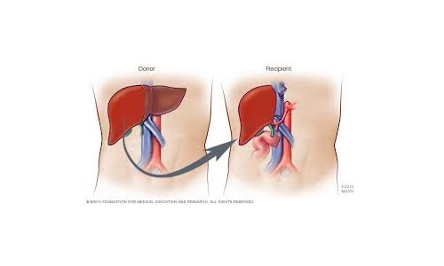 Liver Transplant